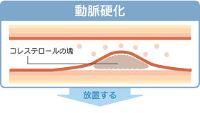 動脈硬化