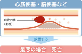 心筋梗塞・脳梗塞