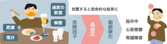 放置すると致命的な結果を招く高血圧