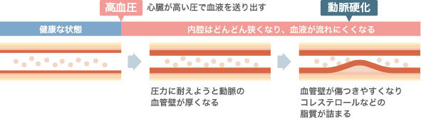 動脈硬化ができる仕組み