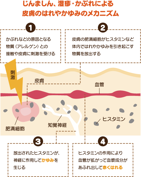 皮膚のはれやかゆみのメカニズム