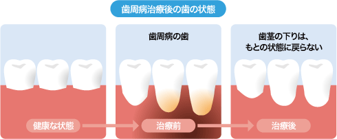 歯周病治療後の歯の状態
