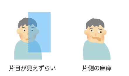 片目が見えずらい・片側の麻痺